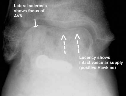 Talar Neck Fractures Trauma Orthobullets talar-neck-fractures-trauma-orthobullets